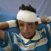 A child who was injured in an airstrike rests in a hospital in Saada, Yemen.