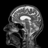 Image of an MRI brain scan