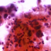 This microscope photo of a Pap test shows the presence of uterine cervical adenocarcinoma.