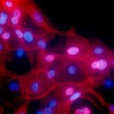 A fluorescence-colored microscope image shows a culture of human breast cancer cells.