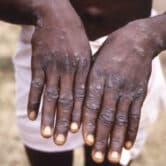 A monkeypox patient in Zaire shows their hands.