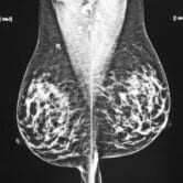 Images of a mammogram scan are displayed on a computer screen