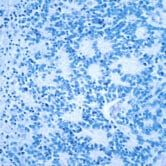 A microscopic photo of neuroblastoma with rosette formation.